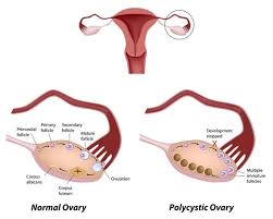 It is characterized by irregular menstrual periods, excess male hormones, and/or ovarian cysts. What Is Polycystic Ovary Syndrome Pcos