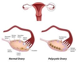 Diagnosis and treatment of polycystic ovary syndrome: Polycystic Ovary Syndrome Pcos Irregular Function Of Ovaries