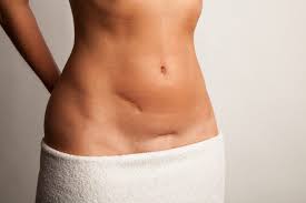 Check spelling or type a new query. Read Our Hernia Repair Faqs Houston Robotic Hernia Surgery Dr Graza