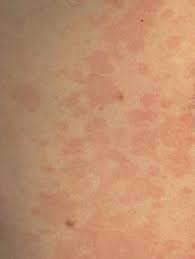 Image result for Skin Infection
