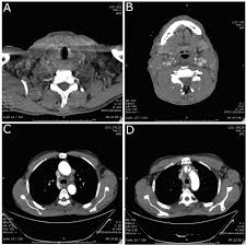 Still, these cancers that have spread to the lymph nodes can often be treated successfully with removal of one lobe or a total thyroidectomy then treated with an. Anaplastic Thyroid Carcinoma With Diffuse Thoracic Skin Metastasis A Case Report