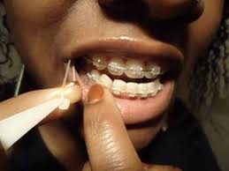 Aug 29, 2017 · here are some tips for adjusting to wearing rubber bands on your braces: How To Put Rubberbands On Braces Youtube