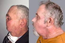 A mulher considerada oficialmente a mais velha do um mundo é a italiana emma morano, que tem hoje 118 anos. Homem Desfigurado Por Tiro Se Torna A Pessoa Mais Velha Do Mundo A Receber Transplante De Rosto