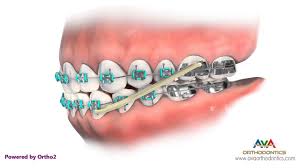 How do braces fix an underbite? Orthodontics Treatment For Underbite Or Crossbite Rubber Bands Youtube