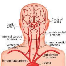 The exam generally includes listening for a swooshing sound (bruit) over the carotid artery in your neck, a sound that's characteristic of a narrowed artery. Abnormalities Of The Head And Neck Arteries Cerebrovascular Abnormalities Children S Wisconsin