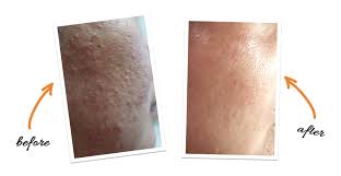 They then move to the surface of the skin, where they become fixed scales. Dry Dehydrated Skin V Magic Digital Experience Center