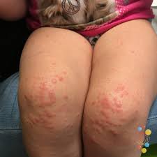 Image result for Papular Acrodermatitis