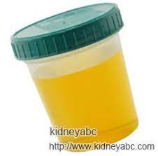 High Levels Of Protein In Urine For Lupus Nephritis Abc
