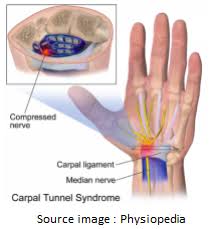 Plusieurs pathologies peuvent créer des symptômes d' engourdissements et de picotements au niveau des membres supérieurs et spécifiquement des mains. 3 Raisons Possibles Aux Engourdissements Et Picotements Des Mains