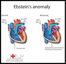 430f1f9ad6233560c4a2d85cce32a295 Jpg 600 581 Pixels Nursing Fun Pediatric Heart Defects Pediatric Heart