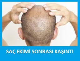 Sac Ekimi Sonrasi Kasinti Sorunu Ve Cozumu Sac Ekimi Destek