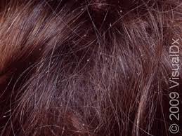 Image result for lice vs dandruff