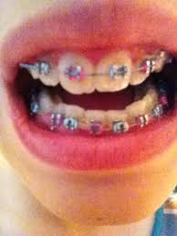 Screaming Pink And Light Blue So Cute Braces Colors Color Inspiration Color