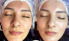 Atención Maicao llegó ⭐BBGlow👸🏻 la innovadora técnica COREANA para lucir  tu piel perfecta reducir manchas, cicatrices de acné y líneas de expresión  🌟para las 4 primeras personas que deseen agendar su cita