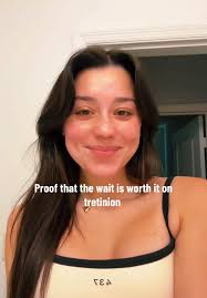 Tretinoin After 8 Months