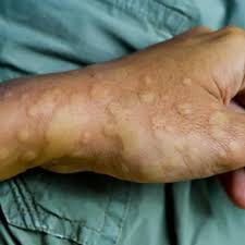 I would recommend you to get investigated thoroughly to find out the cause. Understanding Autoimmune Hives And Its Treatment