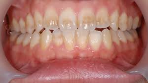 歯の茶渋対策・予防方法 | 尼崎の歯医者 アップル歯科尼崎駅前