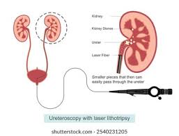 Image result for Nephrolithiasis