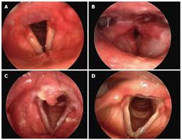 Image result for Reflux Laryngitis
