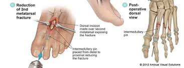 Image result for Metatarsal