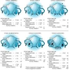 Endo Stage Chart Endometriosis Stages Endometriosis