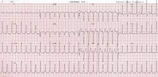 It was formed in 1980 after splitting from sveriges radio, which was responsible for both radio and tv until then. Supraventricular Tachycardia Svt Litfl Ecg Library Diagnosis