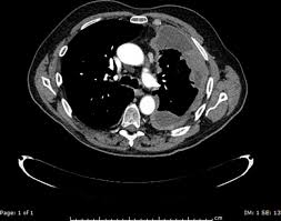 He handles cases that include esophageal achalasia, esophageal diverticulum, myasthenia gravis and interstitial lung disease. Paraneoplastic Phenomenon In Mesothelioma Thorax