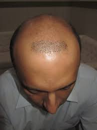 Some people just naturally have a crooked hairline, while for others, an uneven hairline could be the result of a bad haircut. Why Hair Transplant Revisions The Anatomy Of A Bad Hair Transplant