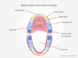 Wisdom teeth removal what you need to know before go. Wisdom Tooth Surgery In Hamburg Germany Zahnklinik Abc Bogen