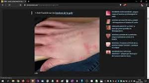 We did not find results for: Gale Cause Symptomes Et Solution Contre La Gale Galle Mon Dermato En Visio