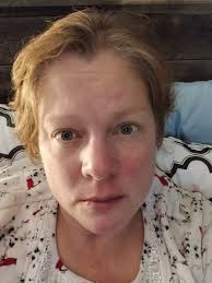 Contracting COVID-19 Multiple Times and Managing Symptoms