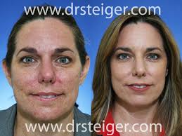 Maybe you would like to learn more about one of these? Fractional Co2 Laser Before And After Photos