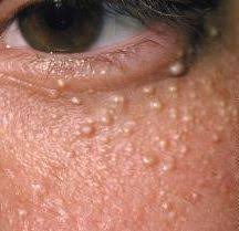 Und letzte etappe der tour de france. Acne 101 White Bumps On Face Milia Under Eyes Bumps Under Eyes