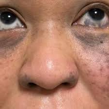 Image result for nevus sclerae