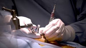 Minimally Invasive Laminectomy Surgery To Treat Lumbar Stenosis Medstar Southern Maryland Youtube