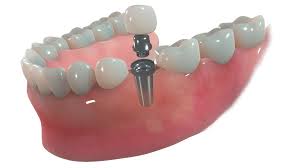 Image result for dental implant
