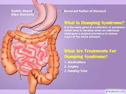 Pin By Maquila On Nursing In 2021 Dumping Syndrome Dumping Syndrome Diet Syndrome