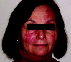 Teaching NeuroImages: Sturge-Weber syndrome presenting in a 58-year-old  woman with seizures