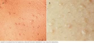 Image result for sweat rash on back