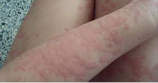 Bed Bug Bites That Look Like Mosquito Bites 7 Types Of Rashes You Should Never Ignore These Are The Warning Signs Types Of Rashes Skin Rashes Pictures Bed Bugs Bites Skin