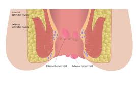 Il primo consiglio, e sicuramente quello più importante, è di aumentare la quantità di fibre che si assumono, sotto forma sono ottimi contro le emorroidi, in particolare i succhi di frutti rossi (ribes, melograno, cigliegia) e quelli di bacche scure (mirtillo, more, ribes nero) perché. Emorroidi Cura Sintomi Cause Rimedi Prevenzione E Dieta