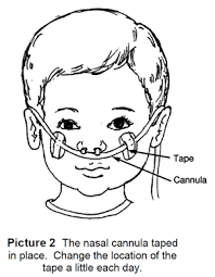 Another type of mask, the venturi mask, delivers oxygen at higher levels. Oxygen Therapy At Home