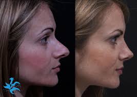 Sono tutte semplicissime da utilizzare e quasi tutte gratuite, almeno nelle loro la prima soluzione che ti consiglio di provare per ritoccare il naso nelle foto è adobe photoshop fix. Modifica Naso Online