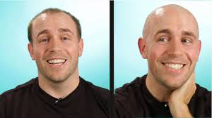 Male pattern baldness tends to develop in three ways: Balding Guys Go Completely Bald Youtube