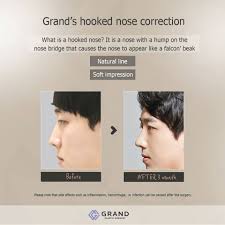 Get Rid Of The Hump On The Nose And Get A Natural And Soft Profile View For Free Consultation Tel 82 70 7119 1580 Natural Line Nose Plastic Surgery