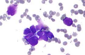 Chronic obstructive pulmonary disease : Small Cell Carcinoma Wikipedia