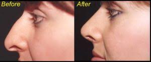 Albuquerque Rhinoplasty