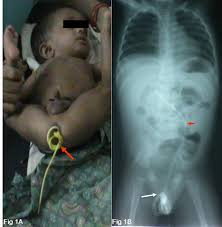 En Masse Protrusion Of Ventriculo Peritoneal Shunt Tube Through The Anus