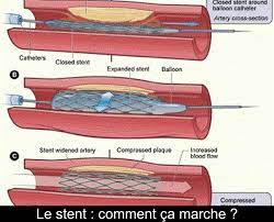 Alors, bien entendu, vivre avec un orgueilleux n'est pas chose facile. Le Stent Comment Ca Marche