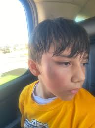 What happened to Isiah's face?